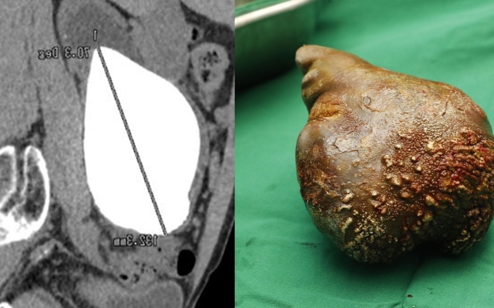 Απίστευτο: Η μεγαλύτερη πέτρα στα νεφρά του κόσμου αφαιρέθηκε στη Σρι Λάνκα>